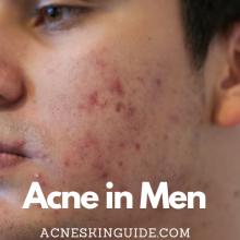 Acne in Men
