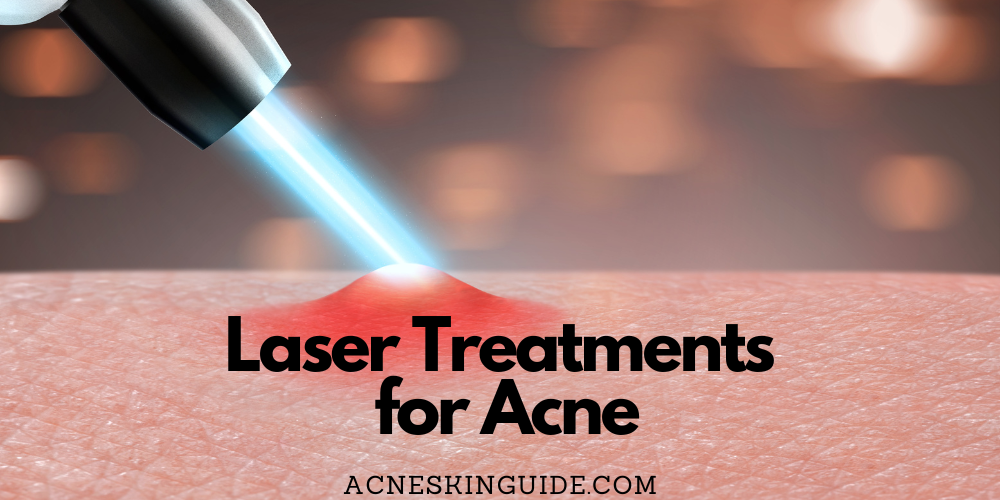 Laser Treatments for Acne