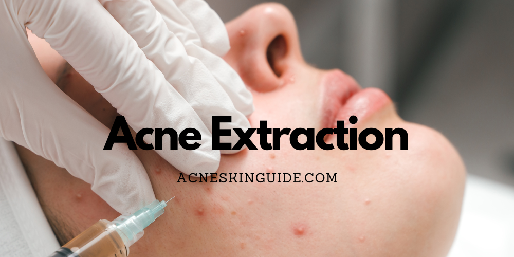 Acne Extraction