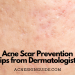 Acne Scar Prevention