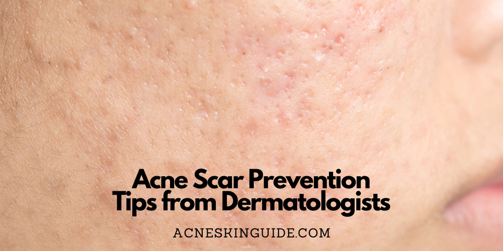 Acne Scar Prevention