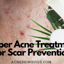 The Importance of Proper Acne Treatment for Scar Prevention