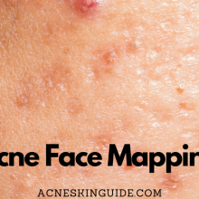 Acne Face Mapping