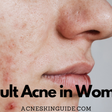 Adult Acne in Women