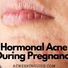 Hormonal Acne During Pregnancy