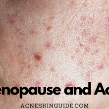Menopause and Acne