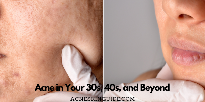 Acne in Your 30s, 40s, and Beyond