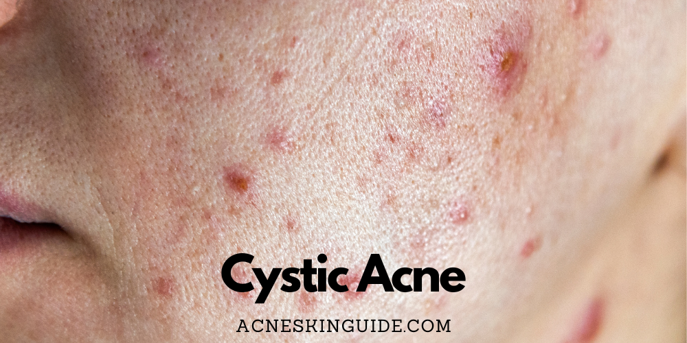 Cystic Acne