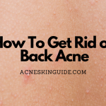 How To Get Rid of Back Acne
