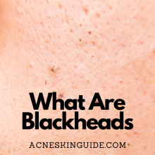 What Are Blackheads